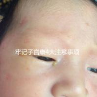 牢記子宮康4大注意事項，輕松避免胃脹、腹瀉等副作用