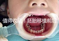 值得收藏!胚胎移植前后這些注意事項都應(yīng)該知道