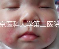 北京醫(yī)科大學第三醫(yī)院nt檢查費用盤點需要多長時間,是否預約