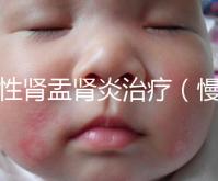 慢性腎盂腎炎治療(慢性腎盂腎炎治療療程)