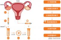 女扎后能做試管嬰兒嗎(45歲結(jié)扎了還能做試管嬰兒嗎)