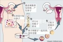 試管嬰兒取卵時疼嗎（試管嬰兒取卵時疼嗎,取卵多長時間才是移植）