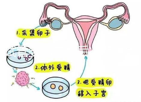 試管嬰兒二超后減藥原因已找到,對(duì)胎兒沒影響別瞎擔(dān)心